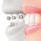 Invisalign Invisalign
